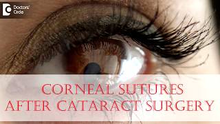 Why are corneal sutures given after Cataract Surgery  Dr Sriram Ramalingam [upl. by Auqinal31]