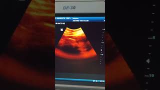 septate uterus ultrasound [upl. by Harriman]