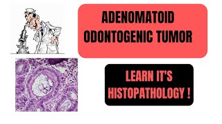 ADENOMATOID ODONTOGENIC TUMORAOT  PART2  LEARN ITS HISTOPATHOLOGY I ORAL PATHOLOGY [upl. by Ennagroeg]