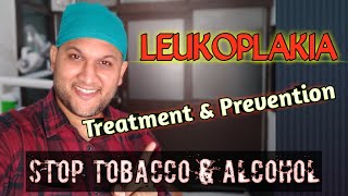 LeukoplakiaTreatment amp Prevention  मुंह में सफेद दाग के लक्षण कारण इलाज  Oral Hairy Leukoplakia [upl. by Wooldridge672]