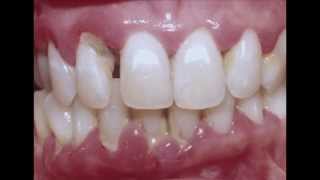 Periodontitis  Cure your Gum with Dr Mark Bonner [upl. by Ignatia]