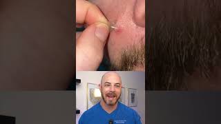 Doctor reacts to slimy pimple patch removal dermreacts doctorreacts pimplepop [upl. by Atterg25]