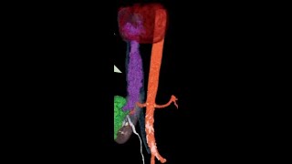 IVC leiomyosarcoma [upl. by Jenine]