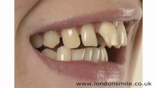 Cosmetic Dental Surgery  London Smile Dental Practice W1 [upl. by Ymma863]