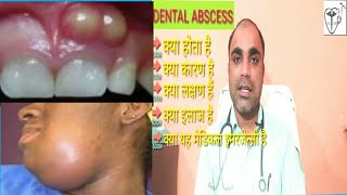 दॉतों में पस से कैसे पायें छुटकारा  Dental Abscess treatment  Dental Abscess types  Dental Absces [upl. by Steddman]