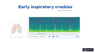 Lung sounds  Early inspiratory crackles [upl. by Aramal]