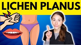 Lichen Planus WHY YOU HAVE IT amp HOW TO TREAT IT [upl. by Eninahs]