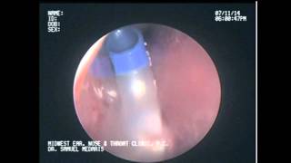 Balloon Sinuplasty of the Maxillary Sinus [upl. by Hedva]