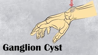 Ganglion Cyst  Surgery Short Cases [upl. by Jard]