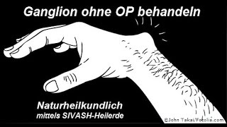 Überbein Ganglion ohne OP behandeln [upl. by Rastus448]