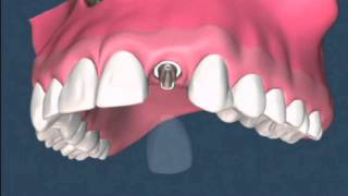 Impianti dentali implantologia 24 video dei trattamenti [upl. by Eimoan996]