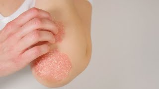 Tratamientos para la psoriasis [upl. by Prent]