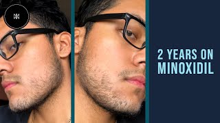 Minoxidil Beard Journey 2 Years [upl. by Nylyrehc655]