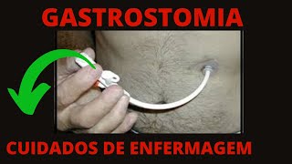 Gastrostomia e a Enfermagem  Cuidados de enfermagem com gastrostomia [upl. by Ettezzus]