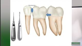 How to make molar extractions easier [upl. by Reppep194]