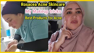 How i Treat my Rosacea acne skin👍No makeup loks Acne issues [upl. by Borries798]