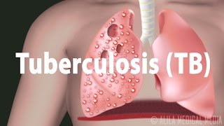 Tuberculosis TB Progression of the Disease Latent and Active Infections [upl. by Kristianson]