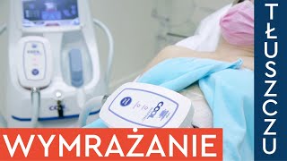 Jak działa kriolipoliza CoolShaping Pokazujemy zabieg wymrażania tłuszczu na brzuchu [upl. by Nylemaj]