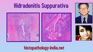 Pathology of Hidradenitis Suppurativa  Dr Sampurna Roy MD dermpath dermatopathology [upl. by Domini]