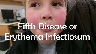 Fifth Disease or Erythema Infectiosum [upl. by Aiveneg]