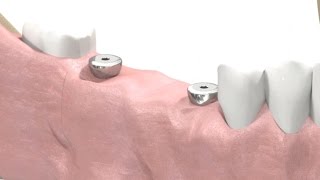 SIC invent Dental Implant  Prosthetic Animation BridgeWork Open Tray Technique [upl. by Cyrus]