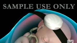 Fetal Distress Ultrasound and Heart Monitor [upl. by Baryram]