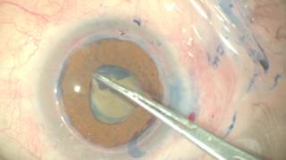 The Triple Procedure  Combined Penetrating Keratoplasty and Cataract Extraction [upl. by Ot8]