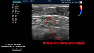 PEC BLOCK ET LOCALISATION DE LARTERE THORACO ACROMIALE [upl. by Teevens718]