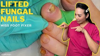 Lifted Fungal Nails Get Ready to Look Fabulous  Miss Foot Fixer [upl. by Aekahs]