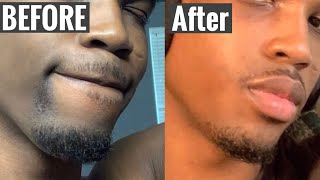 STOP SHAVING  DO THIS INSTEAD  How To Get Rid Of Hyperpigmentation From Shaving For Men [upl. by Auqeenahs]