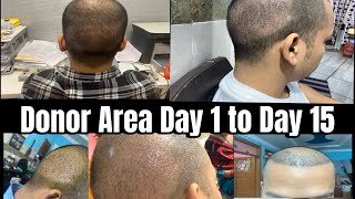 Donor Area recovery after hair transplant  Day 1 to 15 [upl. by Linn]