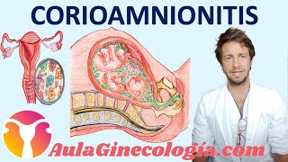 CORIOAMNIONITIS CAUSAS SÍNTOMAS DIAGNÓSTICO TRATAMIENTO Y PREVENCIÓN  Ginecología y Obstetricia [upl. by Farr]