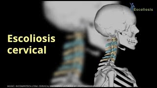 Escoliosis cervical [upl. by Nahsez]