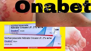 Onabet Cream  Sertaconazole Nitrate Cream Uses in Hindi [upl. by Newmann94]