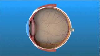 Vitrectomy Surgery for Detached Retina [upl. by Arodnap361]