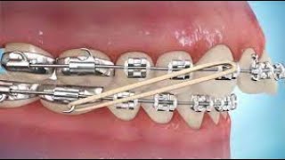 How to put on Class II Elastics [upl. by Sisenej]