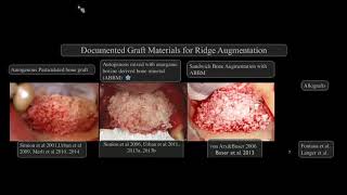 AO Webinar Rewind quotNew Perspectives on Vertical Ridge Augmentationquot Istvan Urban DMD MD PhD [upl. by Fiona]