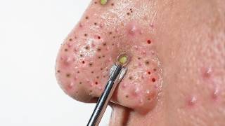 ACNE REMOVAL  Pimple Popping  SATISFYING Blackhead amp Whitehead Extraction [upl. by Rebah]