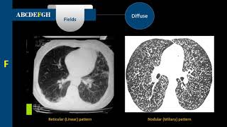 شرح أشعة الصدر  Chest Radiograph  الحلقة الثامنة  Diffuse Lung Patterns [upl. by Red]