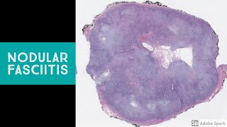 Nodular Fasciitis  Explained by a Soft Tissue Pathologist [upl. by Towers709]