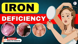 10 Weird Signs Youre Low on Iron  Iron Deficiency Anemia  Iron Deficiency Symptoms [upl. by Nuarb]