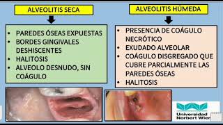 ALVEOLITIS SECA Y HÚMEDA [upl. by Kreitman]