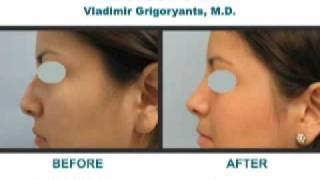 Los Angeles rhinoplasty Nose Job Beverly Hills Dr Vladimir Grigoryants reviews surgery [upl. by Ettennaj]