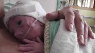 Barnaby Tiny Miracle Amazing story of a premature baby born at 27 weeks UK [upl. by Buzzell]