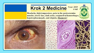 Krok 2 Medicine  Year 2019  045 Ministry of Public Health of Ukraine [upl. by Jolenta]