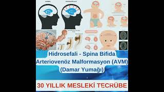 Hidrosefali  Spina Bifida  Arteriovenöz Malformasyon AVM Cerrahisi  30 YILLIK MESLEKİ TECRÜBE [upl. by Moshell583]