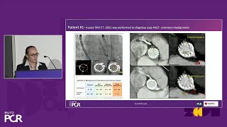 How to overcome the most clinically relevant challenges in TAVI  EuroPCR 2024 [upl. by Dupin37]