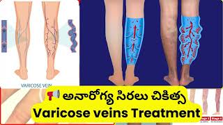 Varicose veins surgery improves వెరికోస్ వీన్స్ సర్జరీ కాళ్ళ మెరుగుపరుస్తుం varicose shorts [upl. by Tennes]