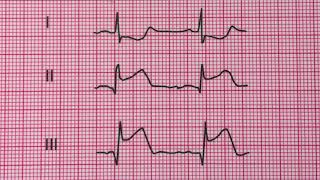 infarctus aigu et inferieur du myocarde [upl. by Aniroz664]