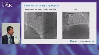 TopShock 2019 honouring the best intravascular lithotripsy cases from the past year  EuroPCR 2019 [upl. by Nahshon]